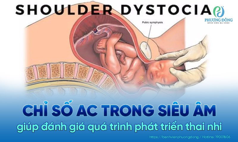 Hình ảnh siêu âm chỉ ra nguy cơ sinh khó do kẹt vai có thể được phát hiện sớm qua chỉ số AC cao khi siêu âm